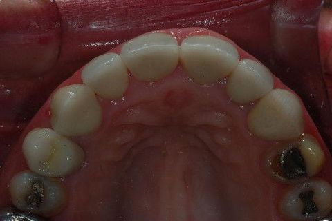 Coroas Cerâmicas como Alternativa Estética para Caso de Alteração Cromática com Tetraciclina.