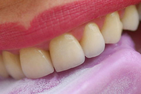 Coroas Cerâmicas como Alternativa Estética para Caso de Alteração Cromática com Tetraciclina.