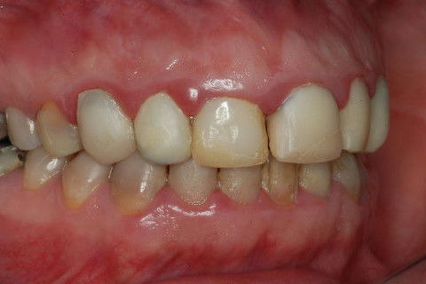 Coroas Cerâmicas como Alternativa Estética para Caso de Alteração Cromática com Tetraciclina.