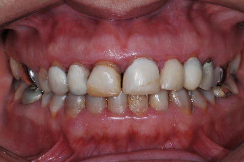 Coroas Cerâmicas como Alternativa Estética para Caso de Alteração Cromática com Tetraciclina.