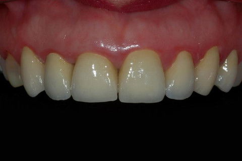 Coroas Cerâmicas como Alternativa Estética para Caso de Alteração Cromática com Tetraciclina.