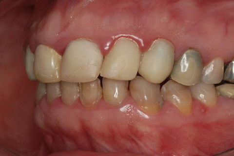 Coroas Cerâmicas como Alternativa Estética para Caso de Alteração Cromática com Tetraciclina.