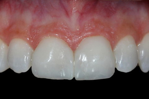 Facetas em Resina Composta