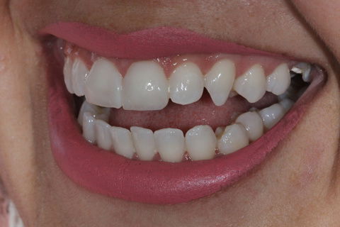 Facetas em Resina Composta