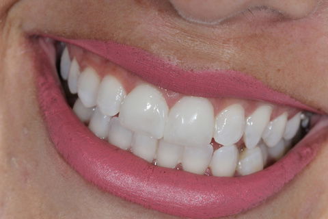 Facetas em Resina Composta