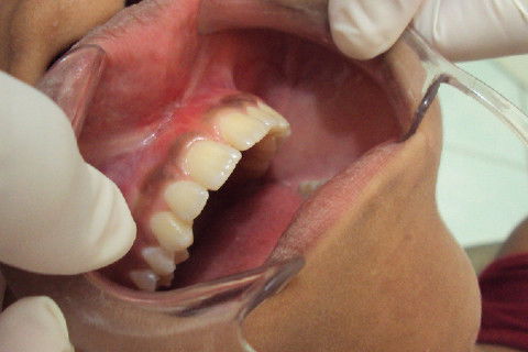 Lateral 15 dias pós cirurgia