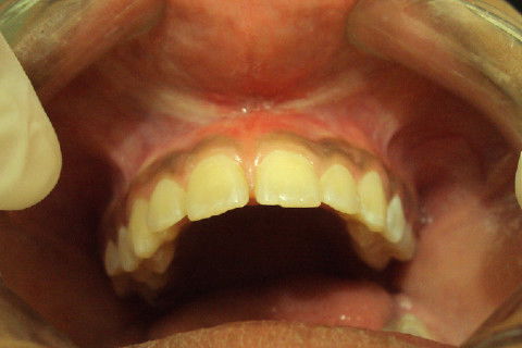 Frontal 15 dias pós cirurgia