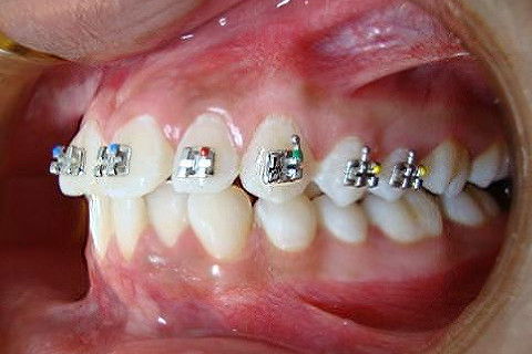 BRUNO ECCHER Ortodontia