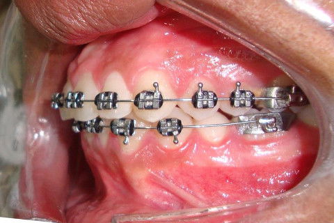 BRUNO ECCHER Ortodontia