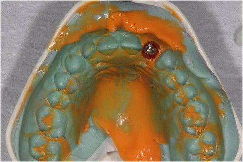 Moldagem de tranferência.