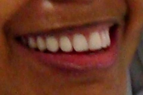 Protocolo Superior - Fase Prótese