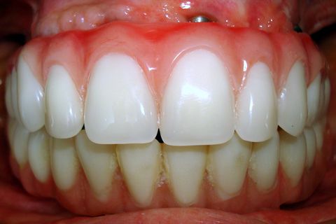 Protocolo Superior - Fase Prótese