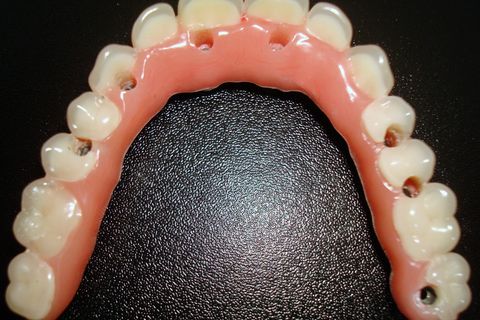 Protocolo Superior - Fase Prótese