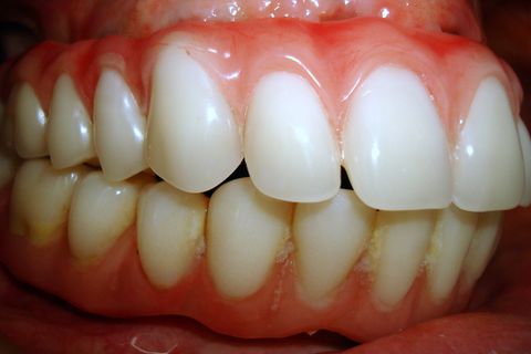 Protocolo Superior - Fase Prótese