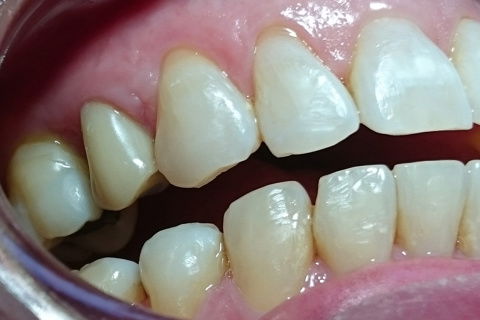 Vista lateral 15 dias após reabertura e função tardia.