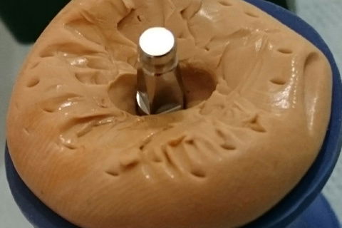 Moldagem da coroa provisória para personalização do transfer.