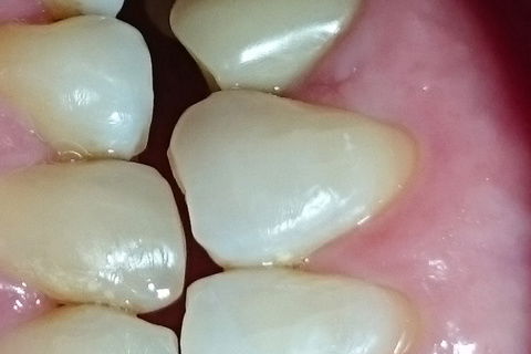 Vista lateral 15 dias após reabertura e função tardia.