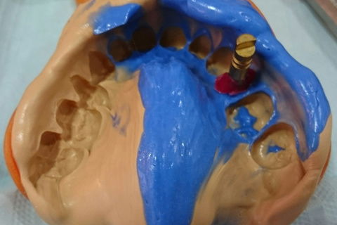 Moldagem de trabalho com transfer personalizado.