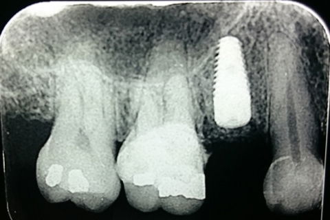 Radiografia 5 meses após implantação
