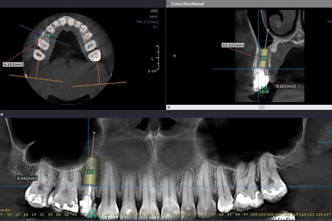 Planejmanento em tomografia