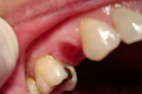 Tecido de revestimento 5 meses após enxerto gengival livre