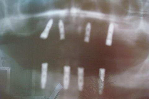 Pós-operatório tardio