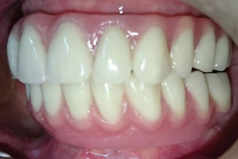 Dia da entrega daspróteses