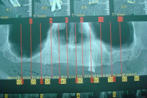 Tomografa pré-operatória
