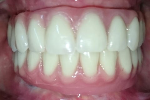 Dia da entrega daspróteses