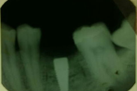 Radiografia imediata