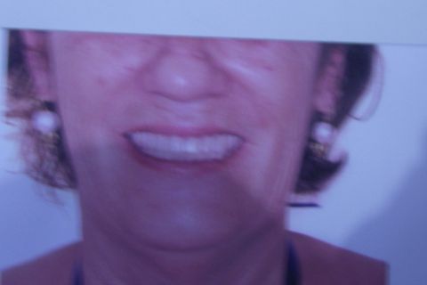 Protocolo Duplo Sendo Superior All-On-4