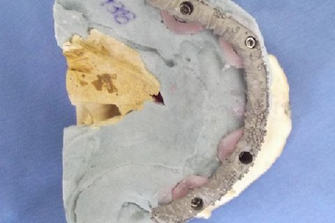 Protocolo Duplo Sendo Superior All-On-4