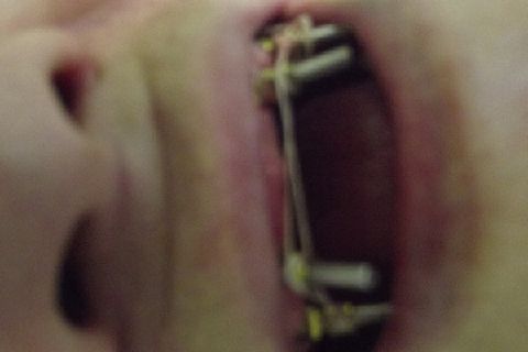 Protocolo Duplo Sendo Superior All-On-4