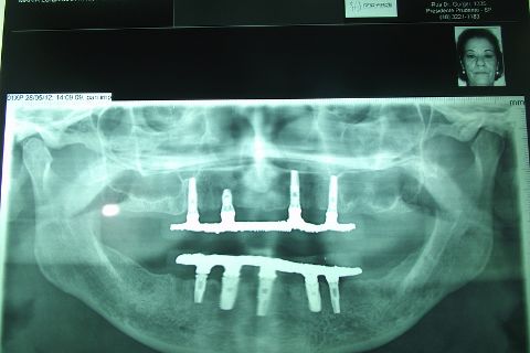 Protocolo Duplo Sendo Superior All-On-4