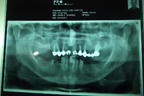 Protocolo Duplo Sendo Superior All-On-4