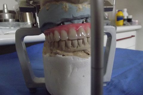 Protocolo Duplo Sendo Superior All-On-4