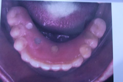 Protocolo Duplo Sendo Superior All-On-4