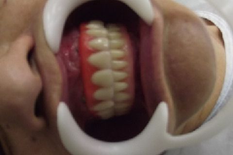 Protocolo Duplo Sendo Superior All-On-4