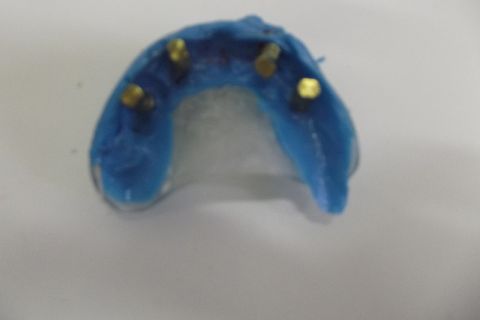 Protocolo Duplo Sendo Superior All-On-4