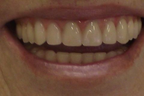 Protocolo Duplo Sendo Superior All-On-4