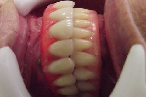 Protocolo Duplo Sendo Superior All-On-4