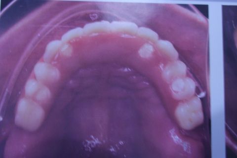 Protocolo Duplo Sendo Superior All-On-4