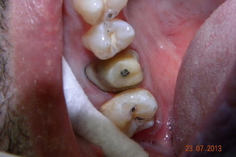 2ª CONSULTA: restauração na face mesial do dente 17.