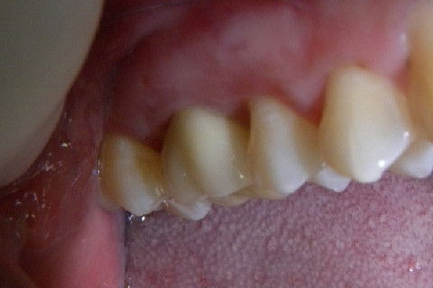 2ª CONSULTA: Coroa e-max instalada