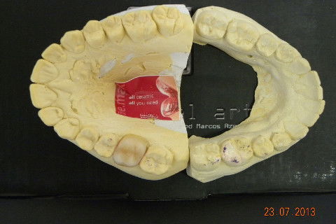 2ª CONSULTA: Coroa pronta e-max