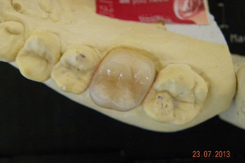 2ª CONSULTA: Coroa pronta e-max