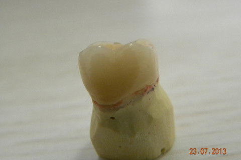 2ª CONSULTA: Coroa pronta e-max