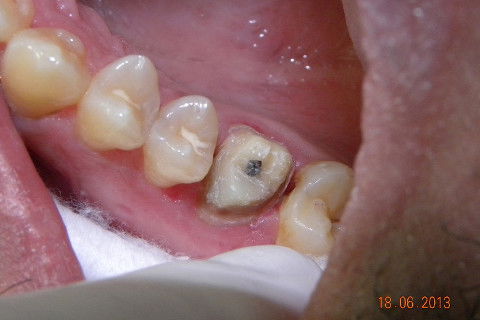 1ª CONSULTA: Núcleo de preenchimento em resina.