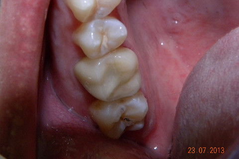 2ª CONSULTA: Coroa e-max instalada