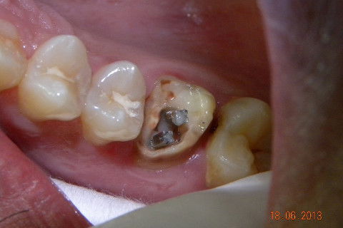 1ª CONSULTA: Instalação de pinos metálicos rosqueáveis